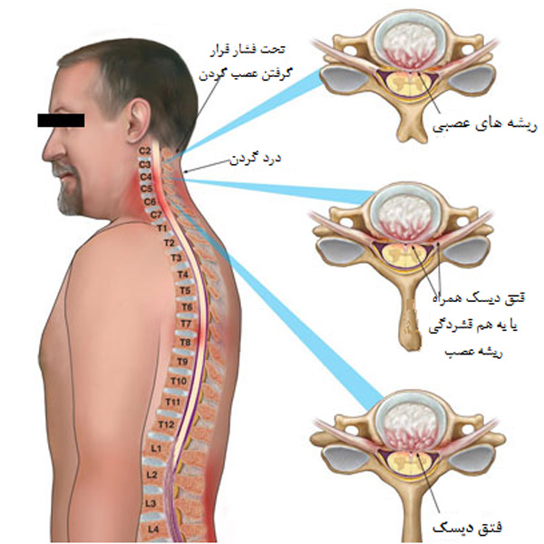علت و درمان دیسک گردن