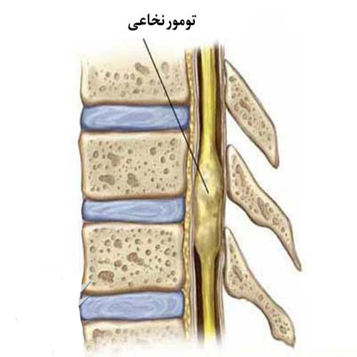 علل و علائم و درمان تومور نخاع