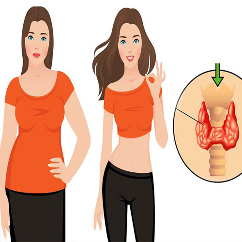 روش سریع کاهش وزن در بیماران کمکار تیروئید